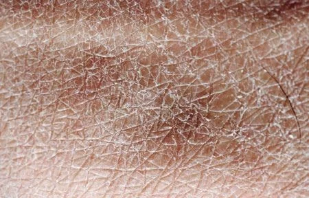 Hình ảnh: Tình trạng da bị khô nghiêm trọng.