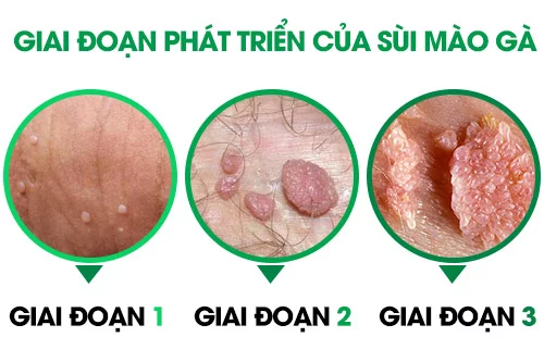 Hình ảnh: sùi mào gà