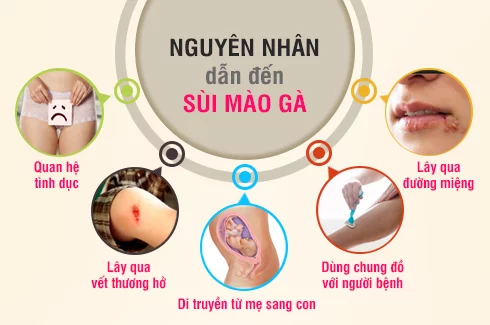 Hình ảnh: Nguyên nhân dẫn đến tình trạng sùi mào gà