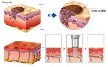 Mô hình cơ chế thực hiện khi thực hiên trẻ hóa da bằng LASER TONING Mô hình cơ chế thực hiện khi thực hiên trẻ hóa da bằng LASER TONING