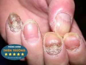 Hình ảnh: Bệnh nấm móng tay