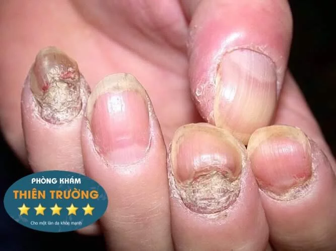 Hình ảnh: Bệnh nấm móng tay