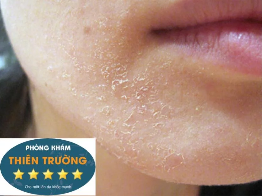 Hình ảnh: Da khô