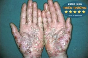 Hình ảnh: Mụn cóc sinh dục ở tay.