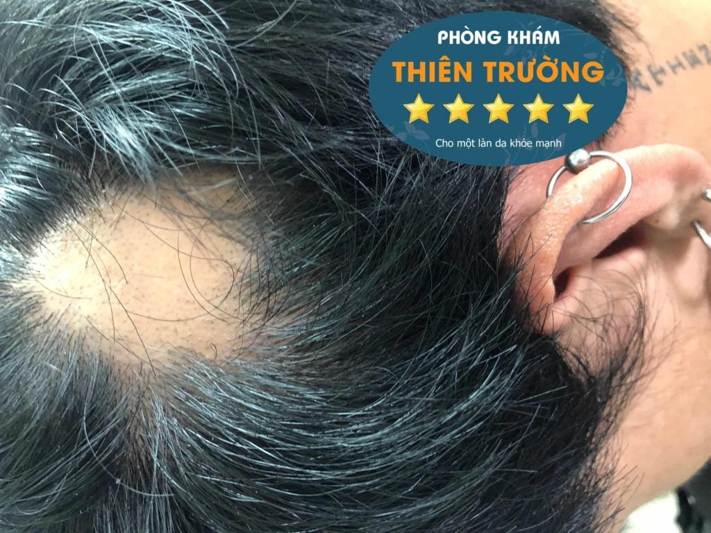 Hình ảnh: Rụng tóc