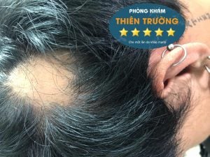 Hình ảnh: Rụng tóc