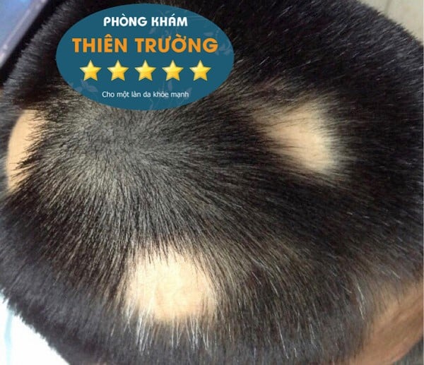 Hình ảnh: Rụng tóc cả mảng