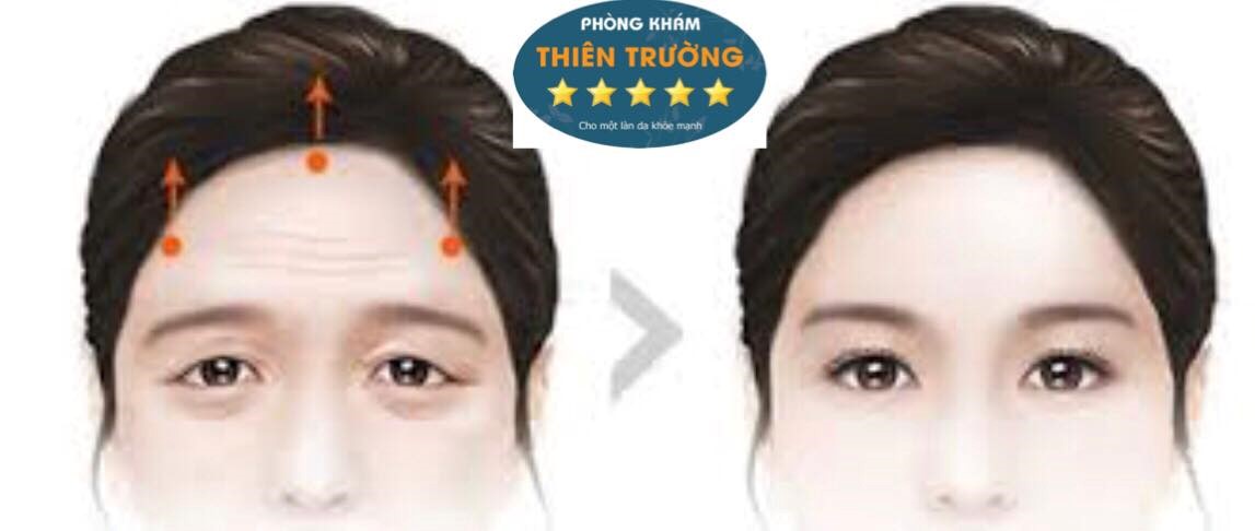 Nâng cung mày không phẫu thuật Hình ảnh: Nâng cung lông mày