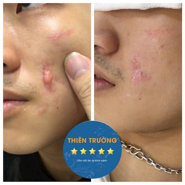 Hình ảnh: Khách hàng sau khi được hỗ trợ điều trị sẹo