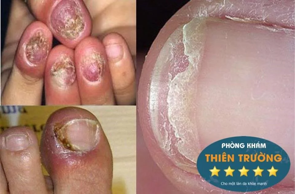 Bệnh nấm móng