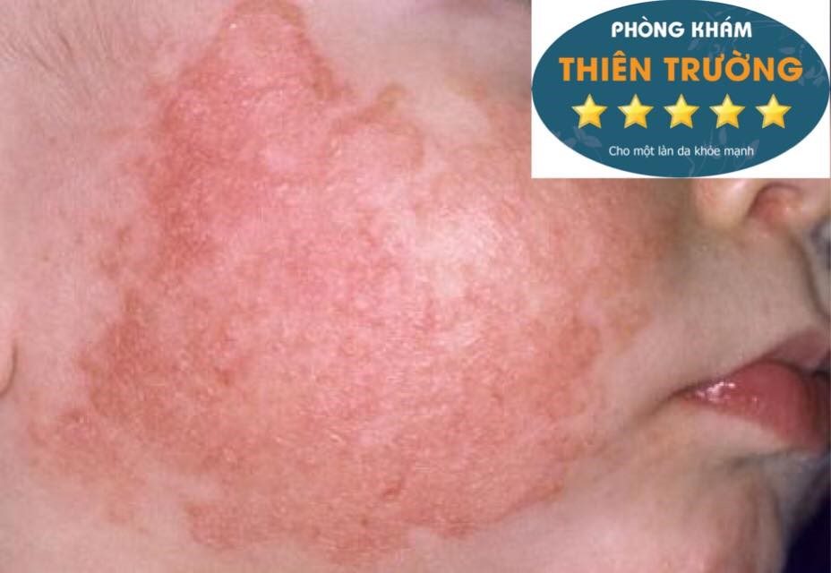 Da khô là gì? Cách Điều Trị Và Chăm sóc da khô Da khô là gì? Cách Điều Trị Và Chăm sóc da khô