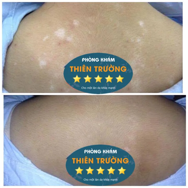 Hình ảnh: Khách hàng trước và sau khi hỗ trợ điều trị bạch biến tại Phòng khám Da liễu Thẩm mỹ Thiên Trường