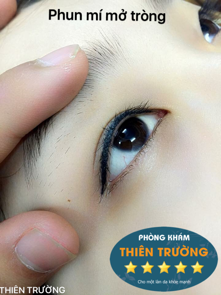 Hình ảnh: Phun mí mở tròng