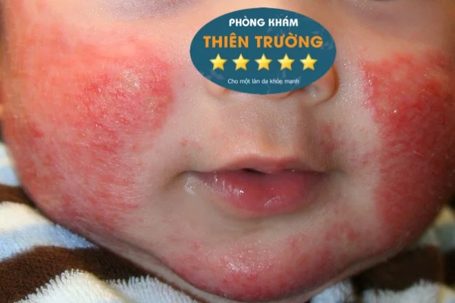 Hình ảnh: Biểu hiện của bệnh Eczema