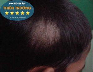 Hình ảnh: Rụng tóc khi bị nấm da đầu