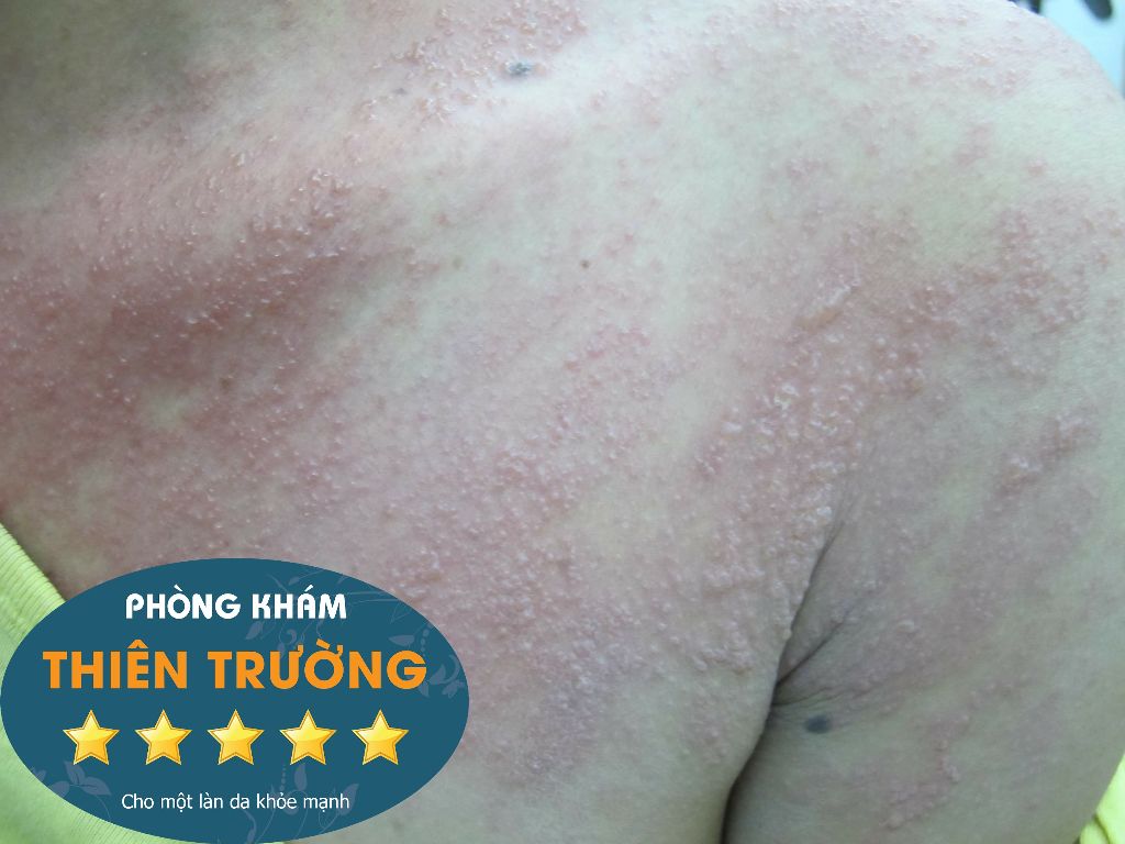 Bệnh zona: Triệu chứng, nguyên nhân và hỗ trợ điều trị