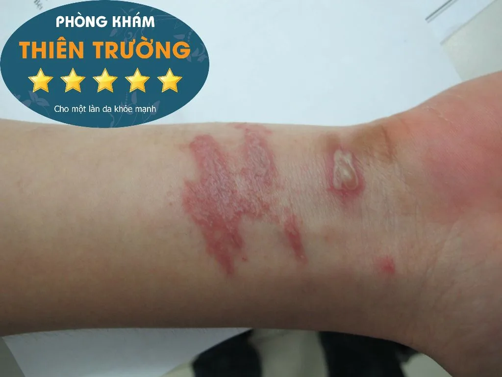 Hình ảnh: Bệnh zona ở tay