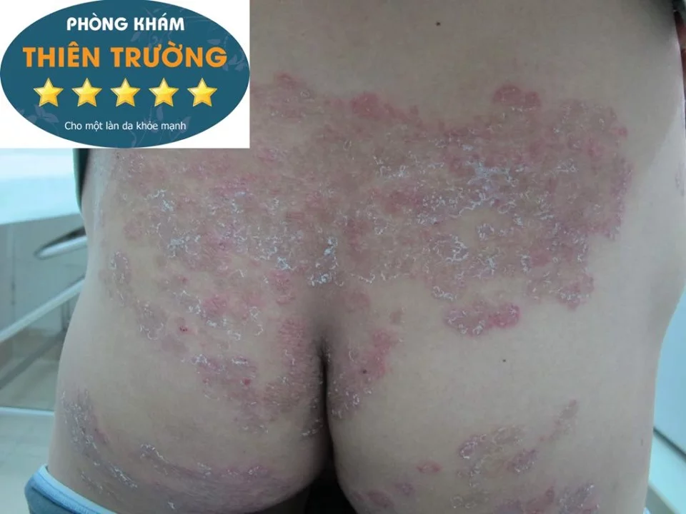 Hình ảnh: Nấm da toàn bộ vùng mông