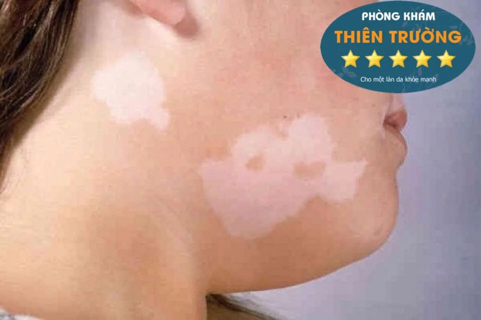 Hình ảnh: Bệnh bạch biến