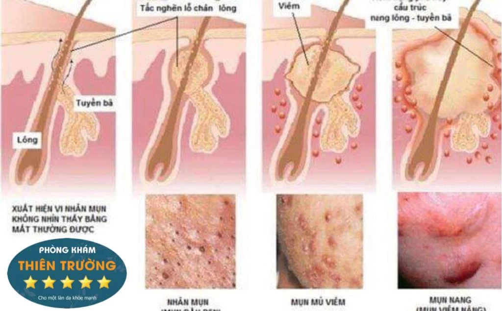 Hình ảnh: Các loại mụn trứng cá
