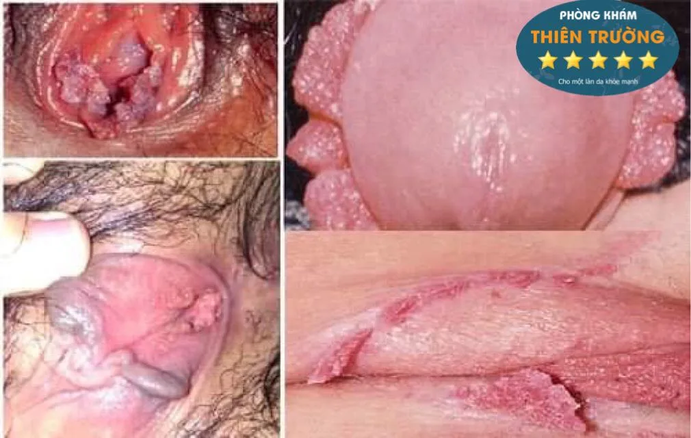 Hình ảnh: Sùi mào gà