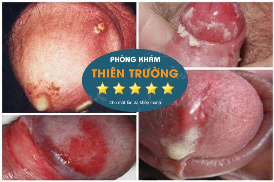 Hình ảnh: Bệnh lậu