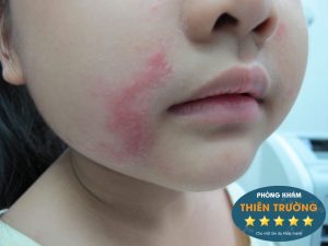 Hình ảnh: Viêm da tiếp xúc