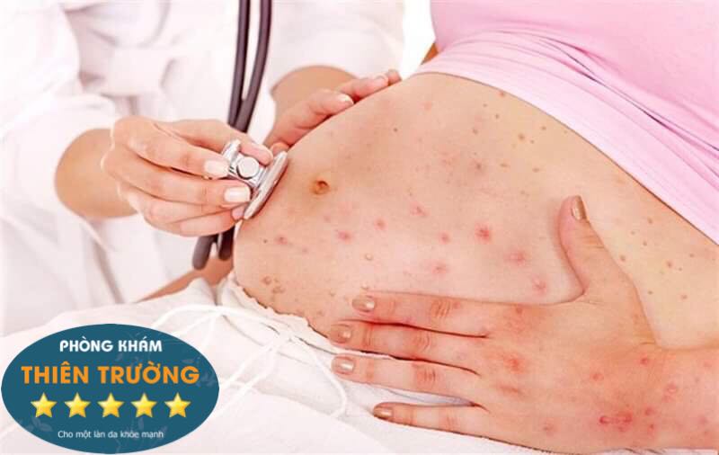 Hình ảnh: Thủy đậu ở phụ nữ mang thai