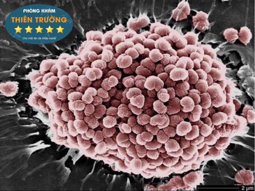 Song cầu khuẩn bệnh lậu Neisseria gonorrhea Hình ảnh: Song cầu khuẩn bệnh lậu Neisseria gonorrhea