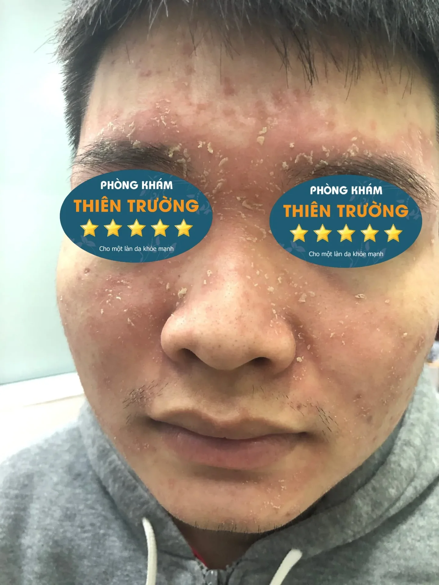 Hình ảnh: Viêm da.