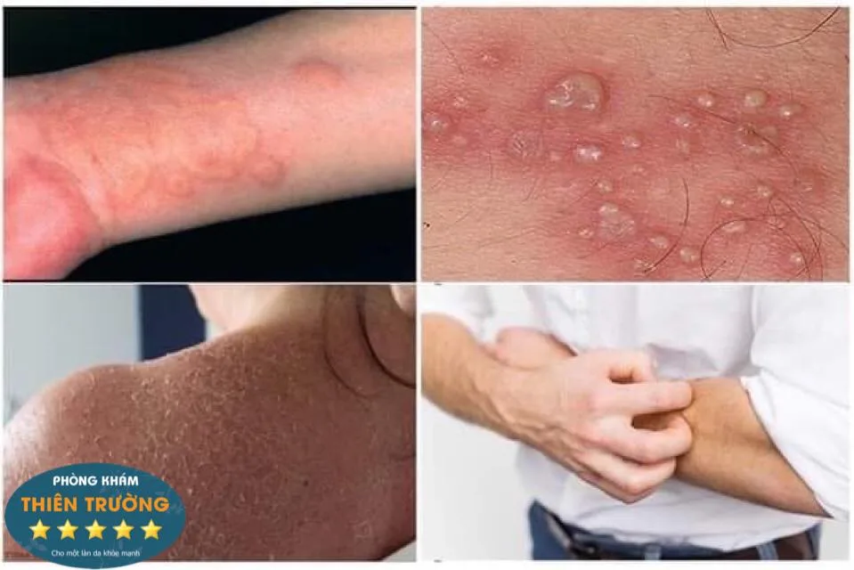 Hình ảnh: Các thể chàm