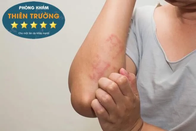 Hình ảnh: Bệnh Eczema