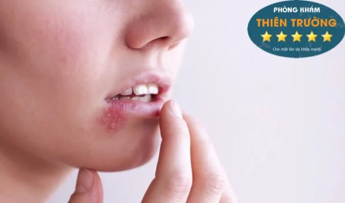 Hình ảnh: Herpes ở miệng