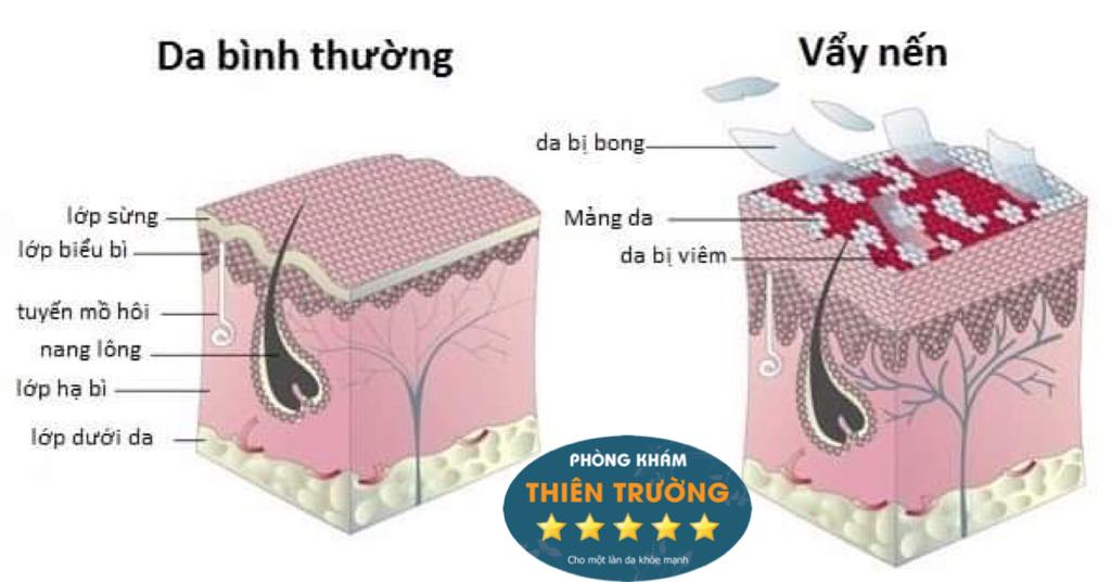 Hình ảnh: Tế bào vảy nến