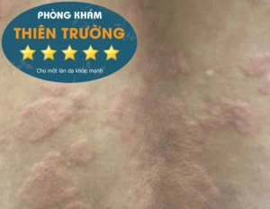 Hình ảnh: Bệnh mề đay xuất hiện trên da