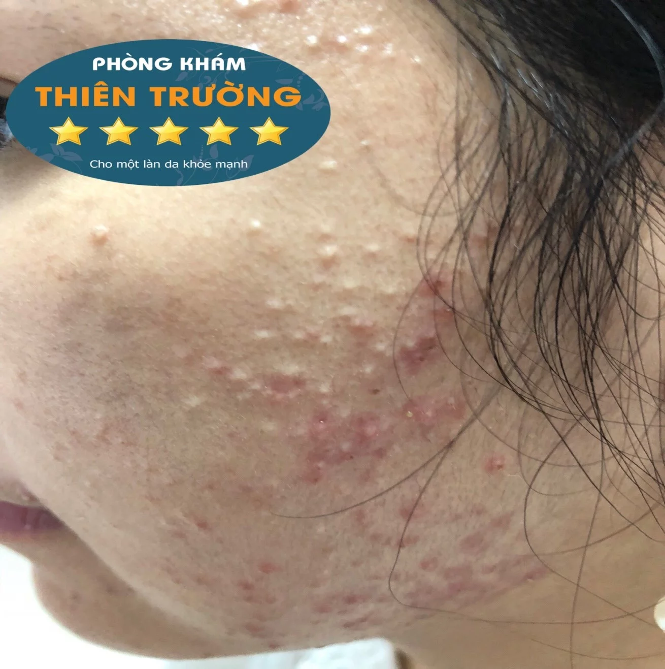 Hình ảnh: Mụn trứng cá