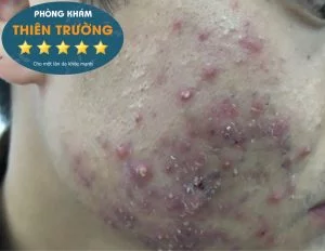 Hình ảnh: Mụn trứng cá bọc.