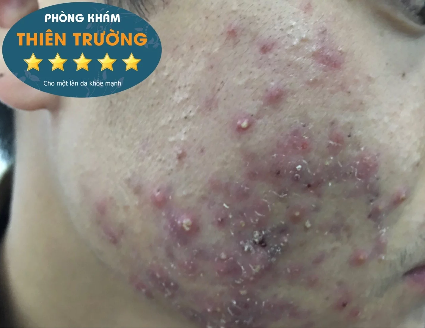Hình ảnh: Bệnh nhân bị mụn trứng cá