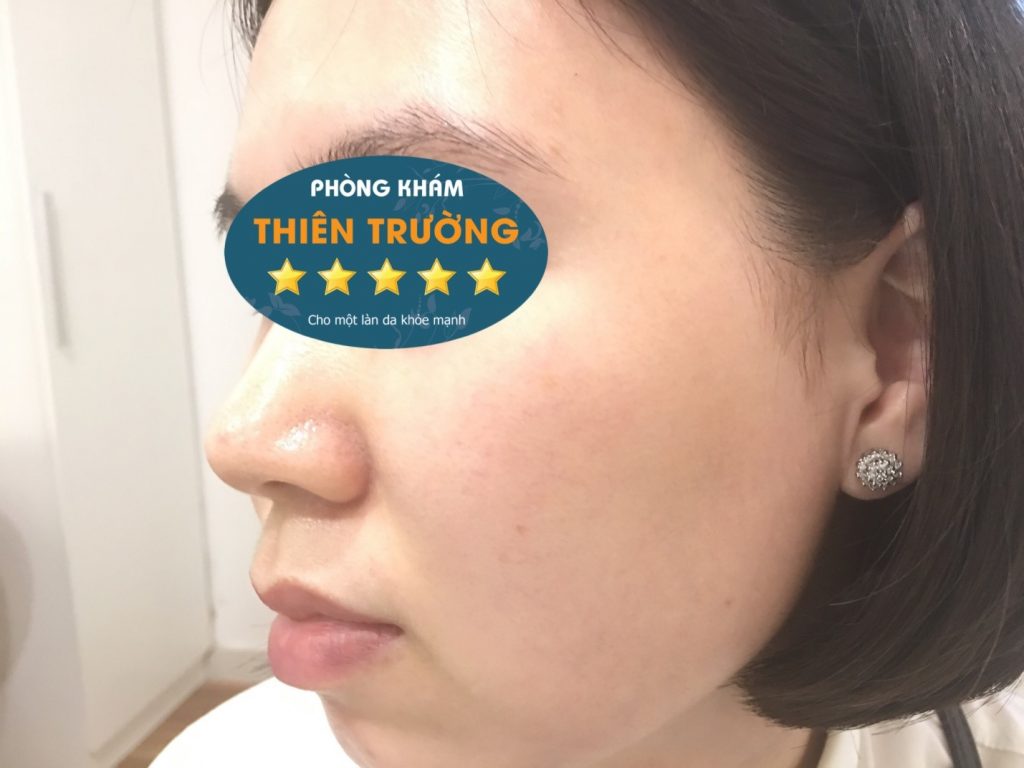 Hình ảnh: Khách hàng sau khi điều trị mụn tại Phòng khám Da liễu Thẩm mỹ Thiên Trường