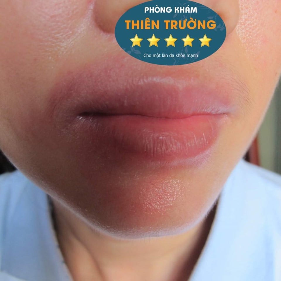 Hình ảnh: Viêm da cơ địa