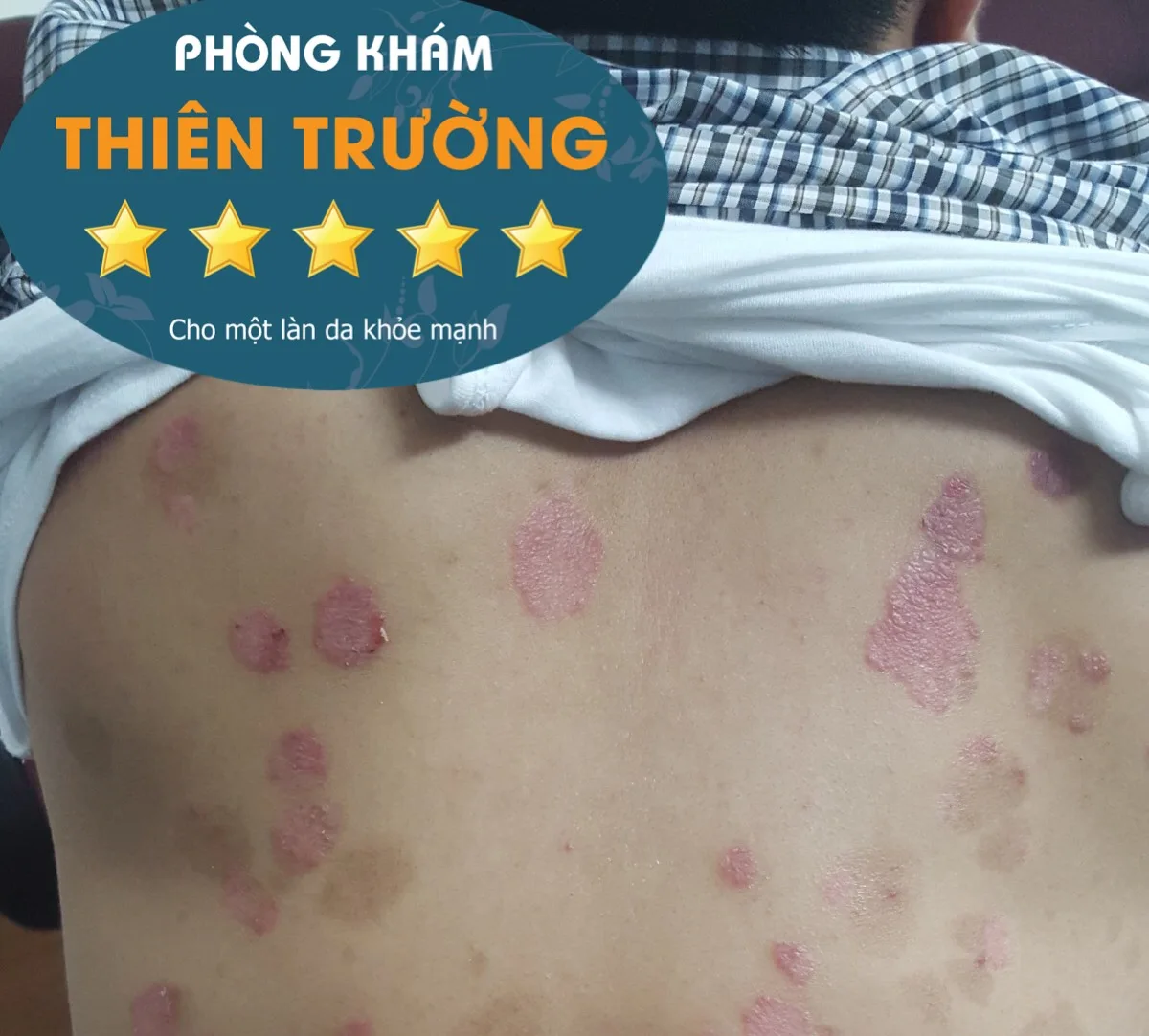 Hình ảnh: Bệnh vảy nến ở lưng