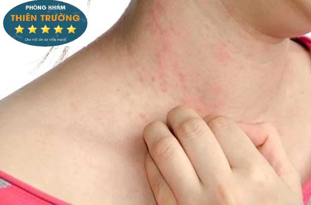 HÌnh ảnh: Bênh viêm da cơ địa gây ngứa ngáy, khó chịu