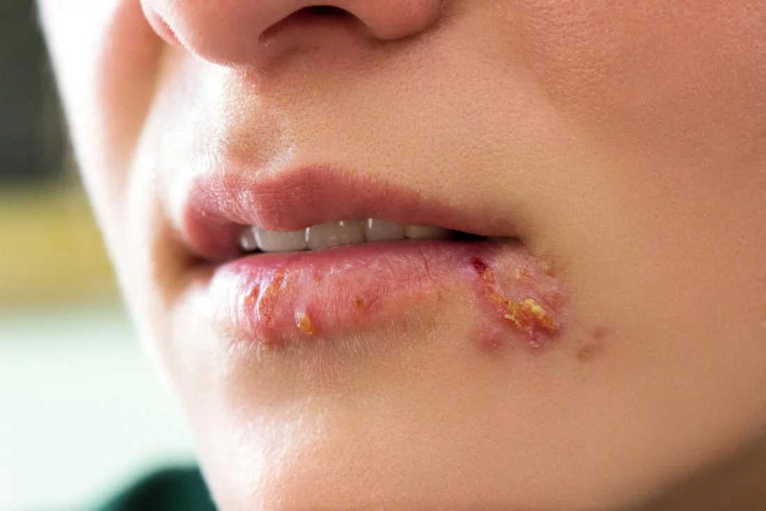 herpes
