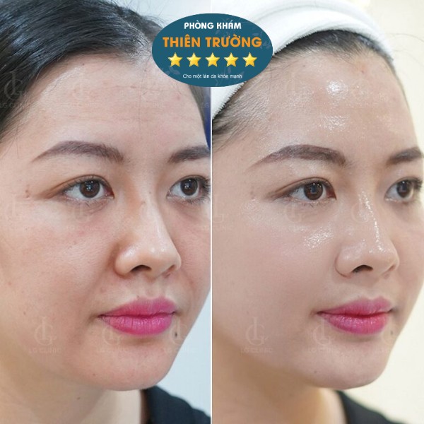 Hình ảnh : Trước và sau điều trị