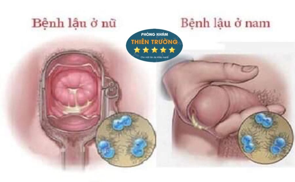 Hình ảnh: Bệnh lậu