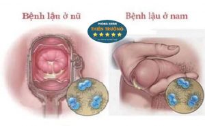 Hình ảnh: Bệnh lậu