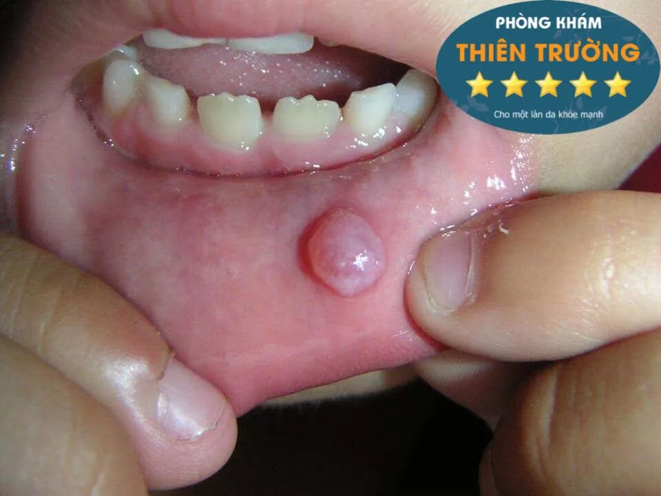 Hình ảnh: Herpes ở trong miệng