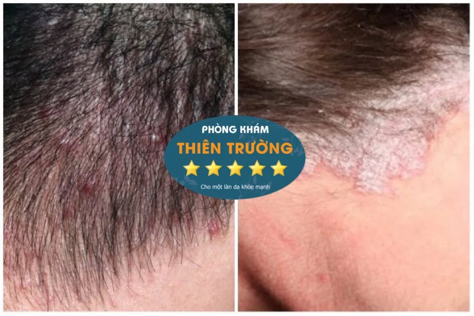 Hình ảnh: nấm da đầu