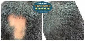 Hình ảnh: Khách hàng sau khi được hỗ trợ điều trị rụng tóc