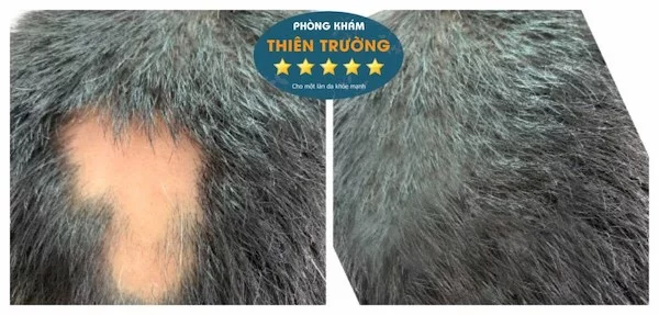 Hình ảnh: Khách hàng sau khi được hỗ trợ điều trị rụng tóc